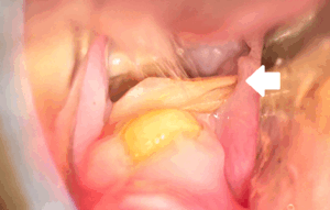 うさぎ不正咬合
